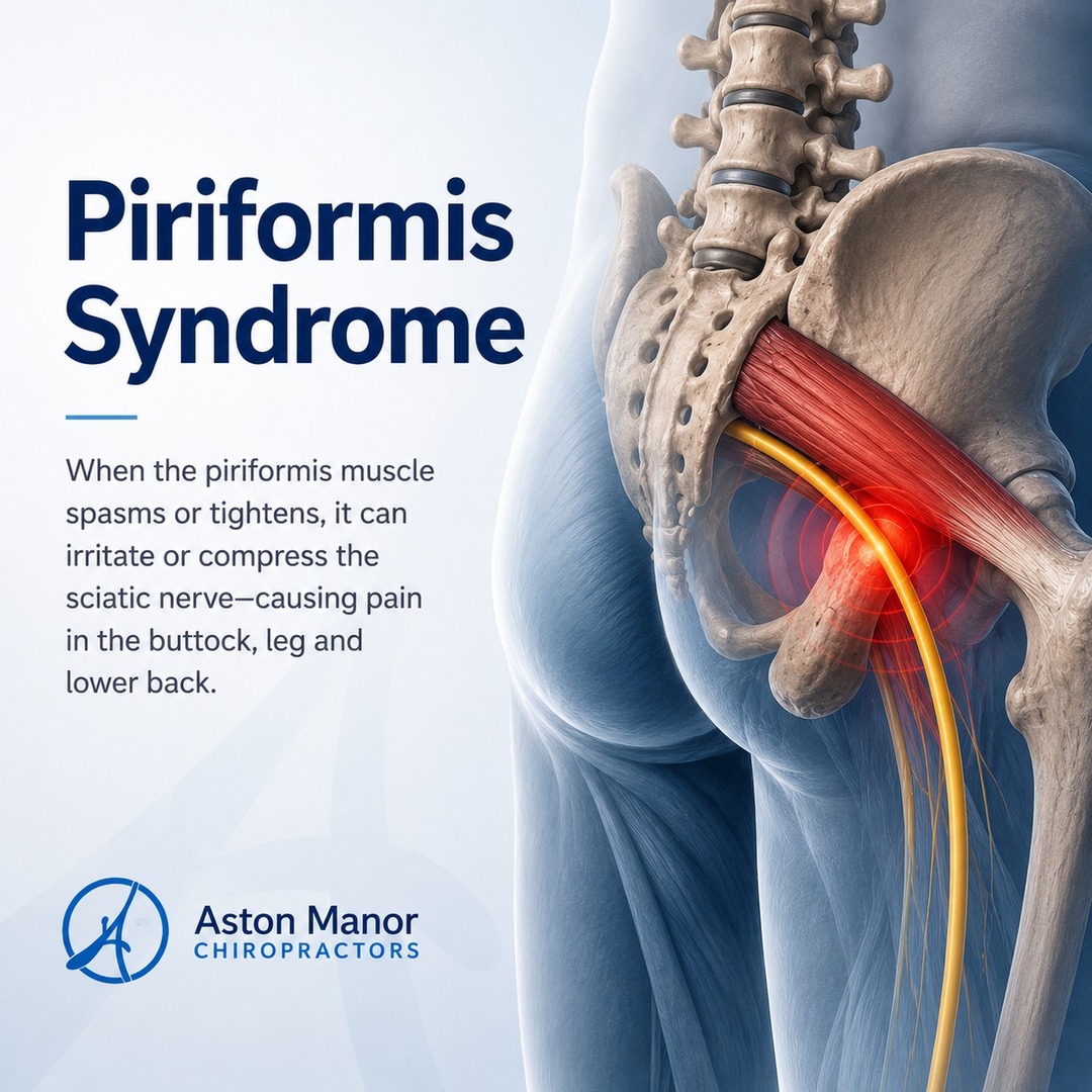 piriformis_syndrome_square_under_2mb